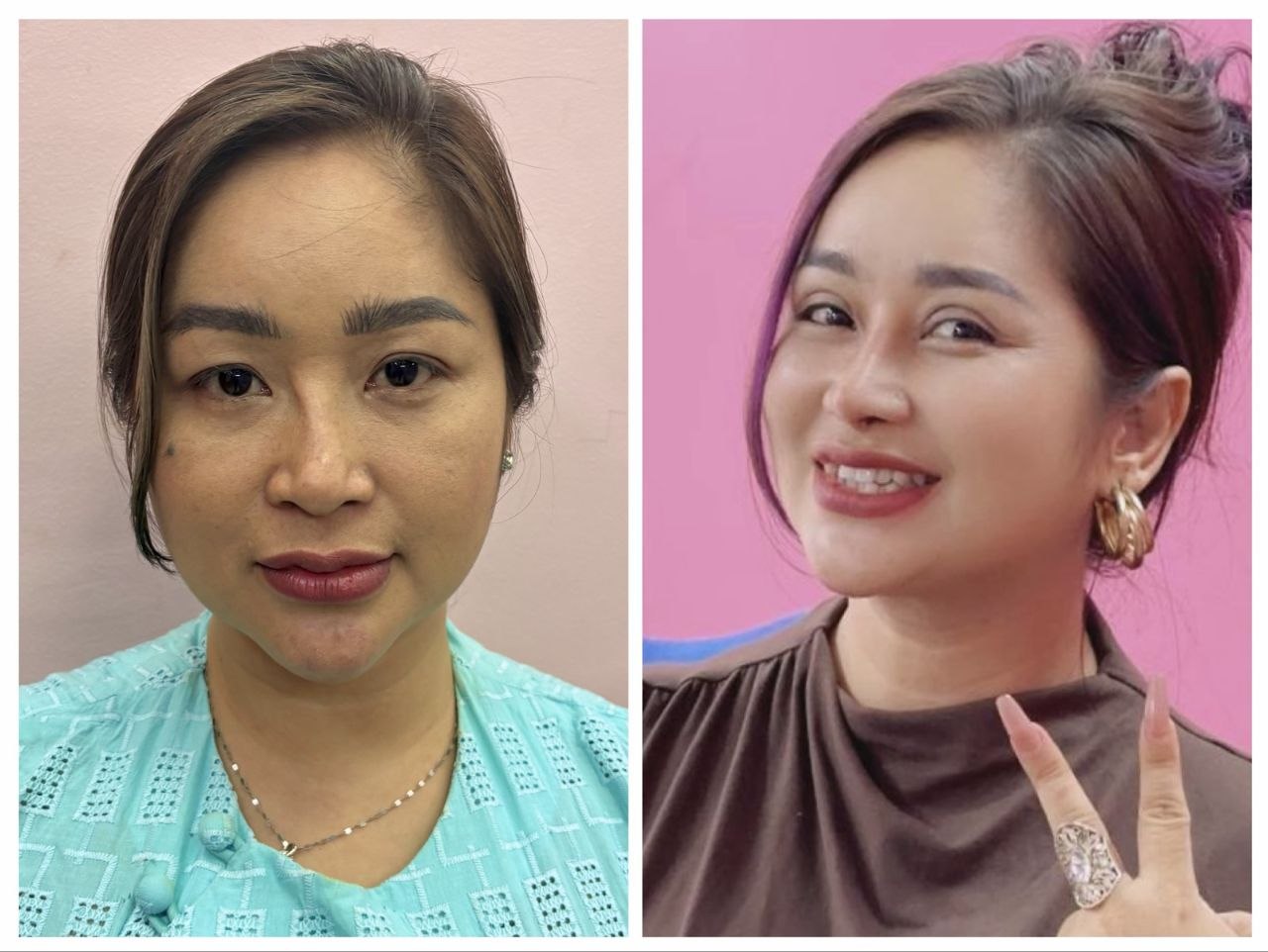 Treatment Result 2