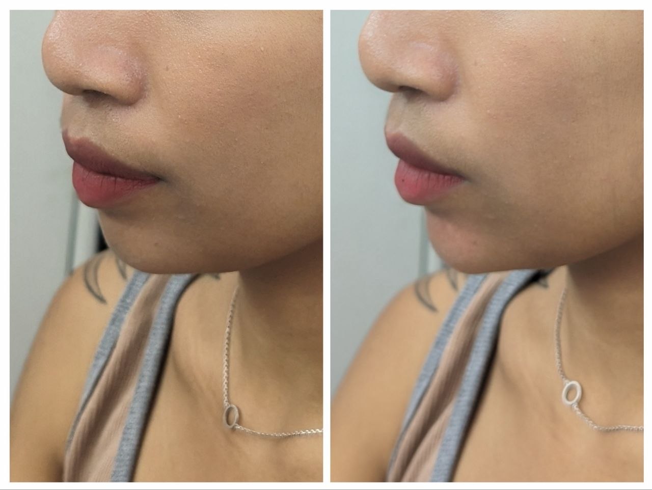 Treatment Result 4